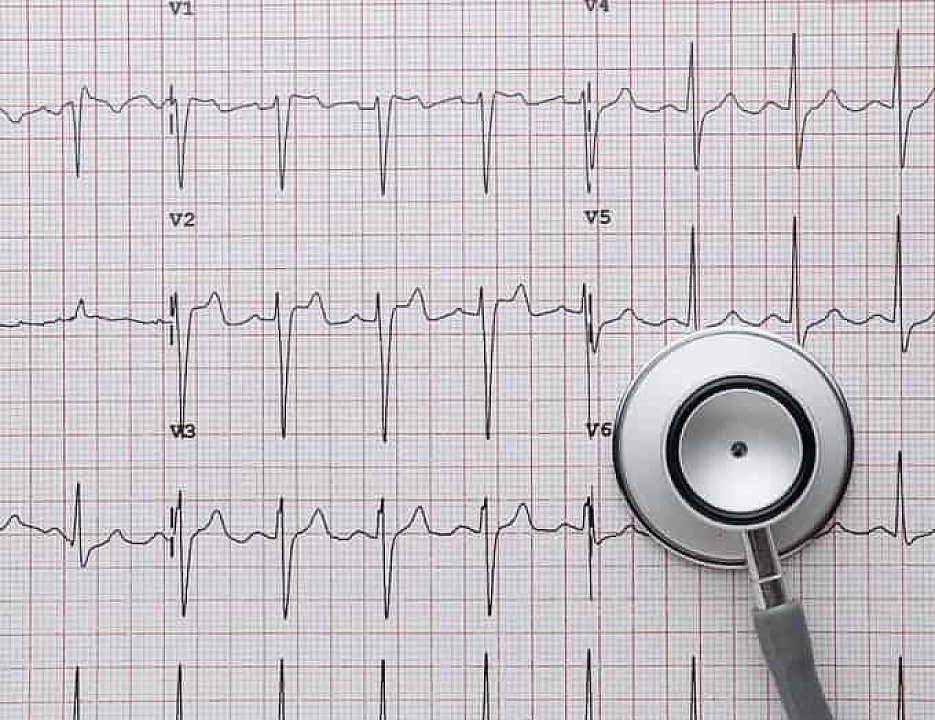 Нейросеть научили распознавать следы сердечно-сосудистых заболеваний по ЭКГ