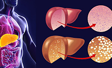 Неалкогольная жировая болезнь печени: опубликованы новые клинические рекомендации